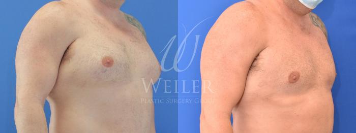 Before & After Male Breast Reduction Case 771 Right Oblique View in Baton Rouge, New Orleans, & Lafayette, Louisiana