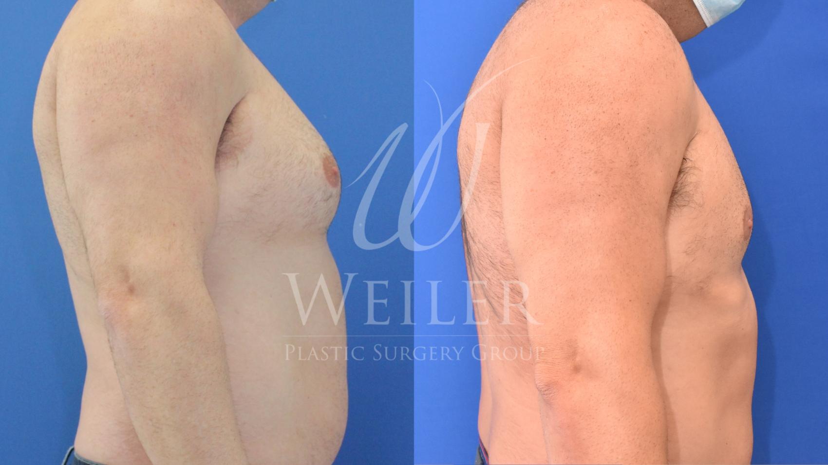 Before & After Male Breast Reduction Case 771 Right Side View in Baton Rouge, Louisiana