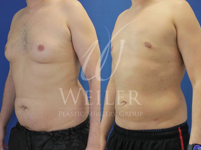 Before & After Male Breast Reduction Case 855 Left Oblique View in Baton Rouge, New Orleans, & Lafayette, Louisiana