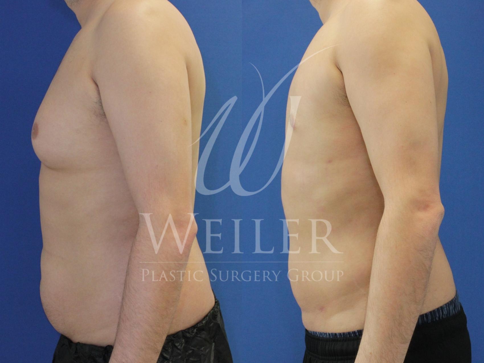 Before & After Male Breast Reduction Case 855 Left Side View in Baton Rouge, New Orleans, & Lafayette, Louisiana