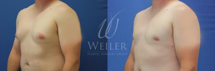 Before & After Male Breast Reduction Case 859 Left Oblique View in Baton Rouge, New Orleans, & Lafayette, Louisiana
