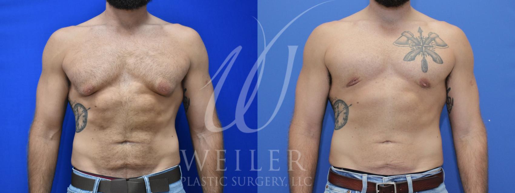 Before & After Male Breast Reduction Case 921 Front View in Baton Rouge, New Orleans, & Lafayette, Louisiana
