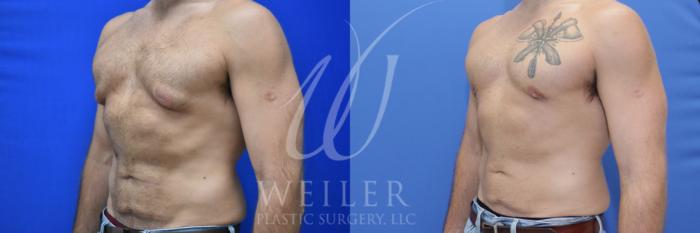 Before & After Male Breast Reduction Case 921 Left Oblique View in Baton Rouge, New Orleans, & Lafayette, Louisiana
