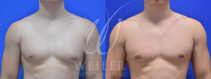 Before & After Male Breast Reduction Case 941 Front View in Baton Rouge, New Orleans, & Lafayette, Louisiana