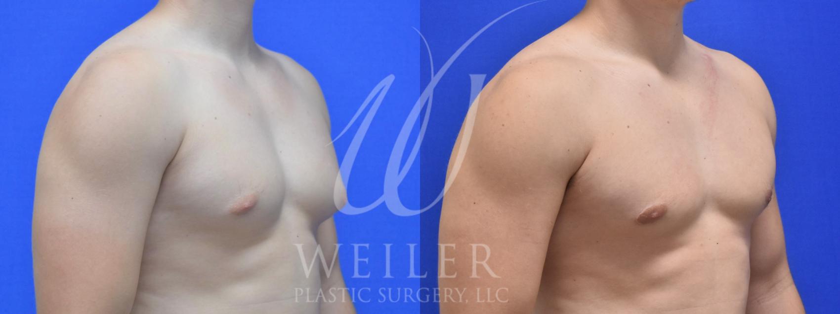 Before & After Male Breast Reduction Case 941 Left Oblique View in Baton Rouge, New Orleans, & Lafayette, Louisiana