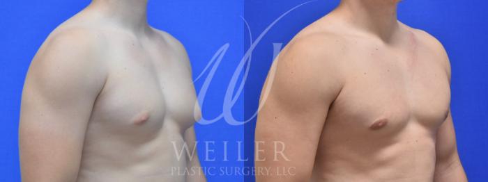 Before & After Male Breast Reduction Case 941 Left Oblique View in Baton Rouge, Louisiana