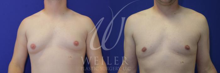Before & After Male Breast Reduction Case 963 Front View in Baton Rouge, Louisiana