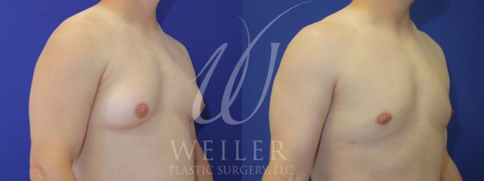 Before & After Male Breast Reduction Case 963 Right Oblique View in Baton Rouge, Louisiana