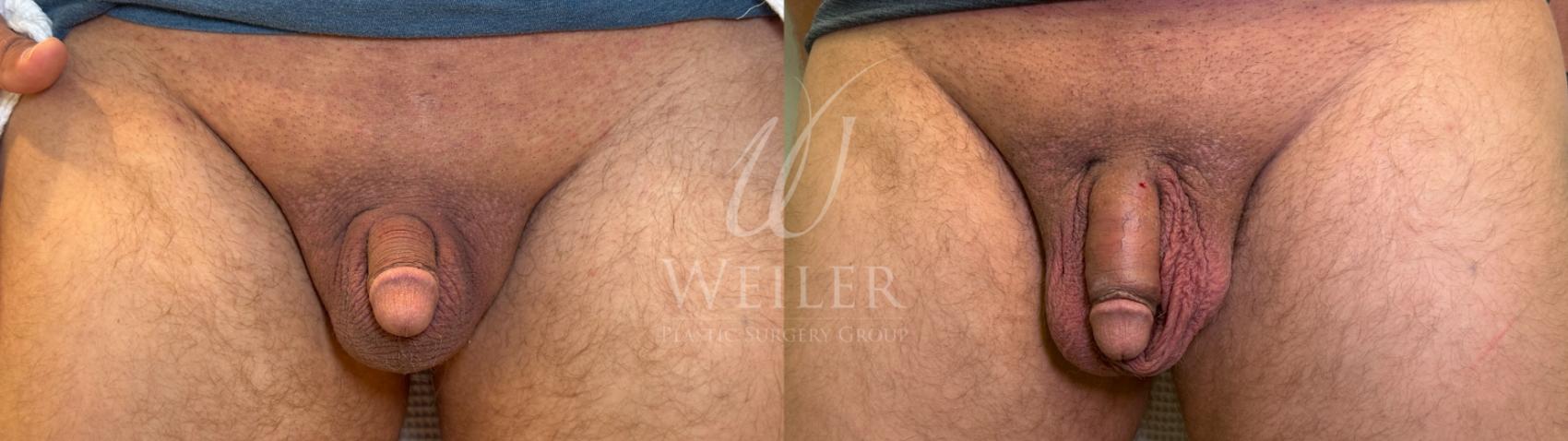 Before & After Male Enhancement Filler Case 1713 Front View in Baton Rouge, New Orleans, & Lafayette, Louisiana