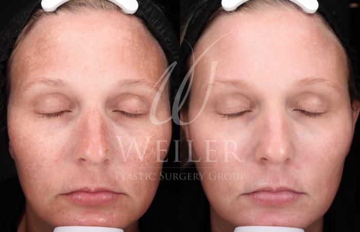 Before & After Medical Grade Skincare Case 1437 Front View in Baton Rouge, New Orleans, & Lafayette, Louisiana