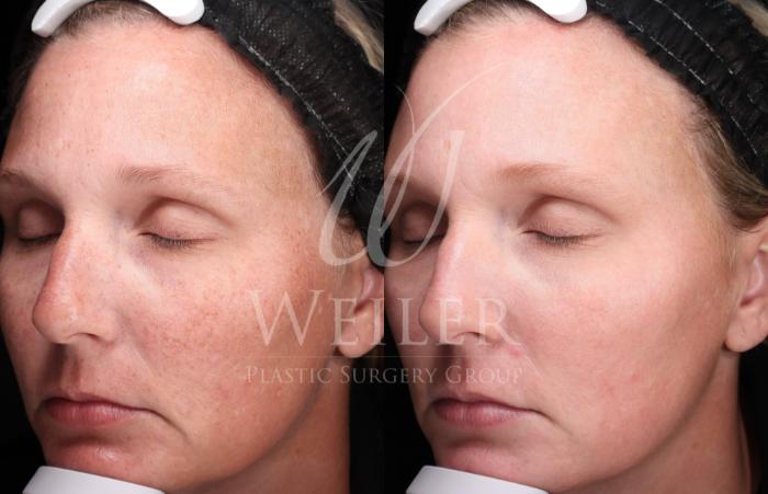 Before & After Medical Grade Skincare Case 1437 Left Oblique View in Baton Rouge, New Orleans, & Lafayette, Louisiana