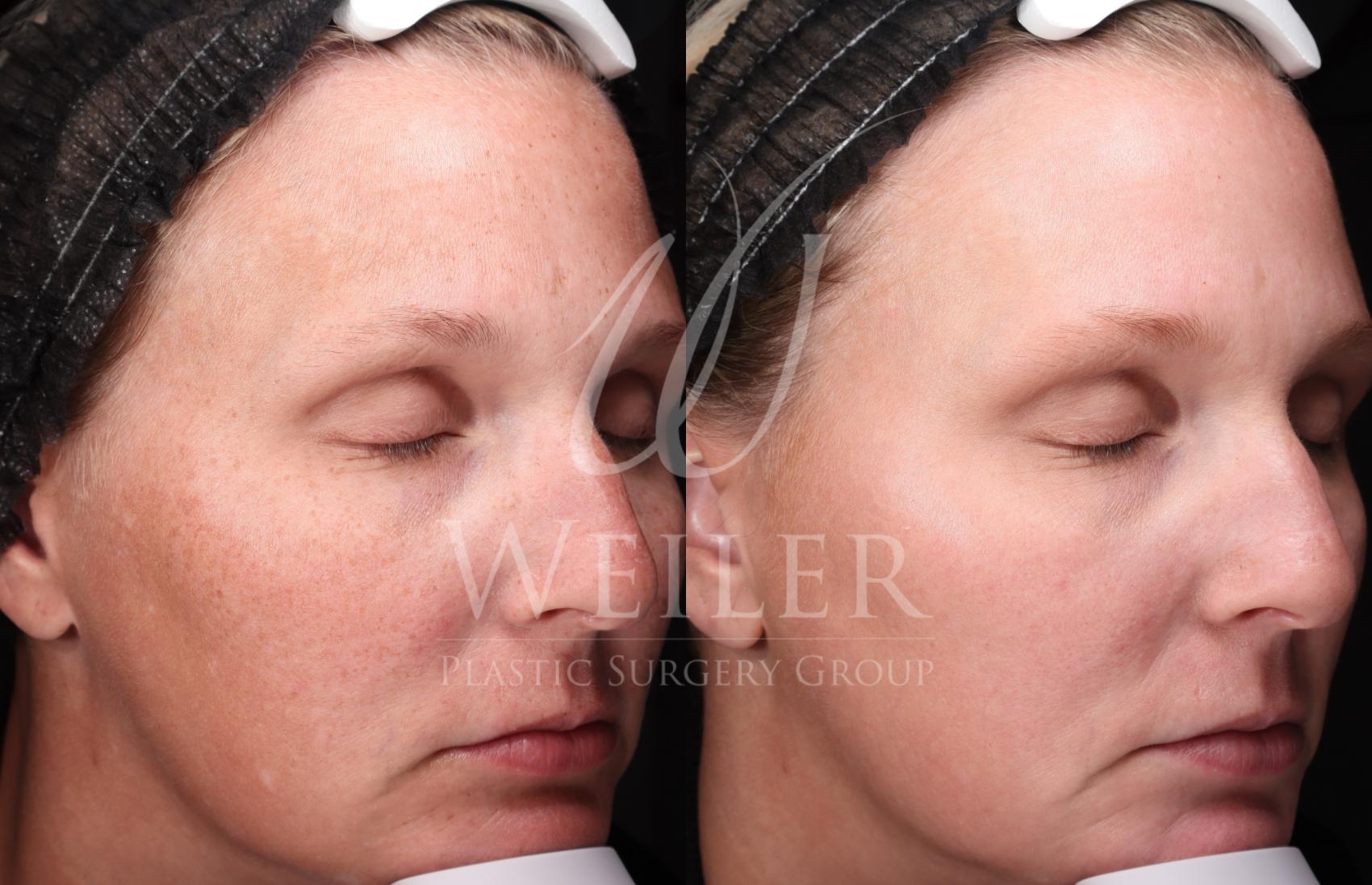 Before & After Medical Grade Skincare Case 1437 Right Oblique View in Baton Rouge, New Orleans, & Lafayette, Louisiana