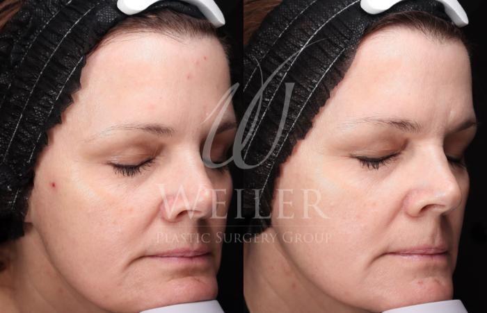 Before & After Microneedling Case 1428 Right Oblique View in Baton Rouge, New Orleans, & Lafayette, Louisiana