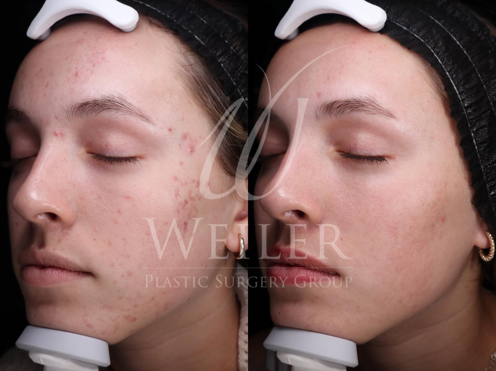 Before & After Microneedling Case 1657 Left Oblique View in Baton Rouge, New Orleans, & Lafayette, Louisiana