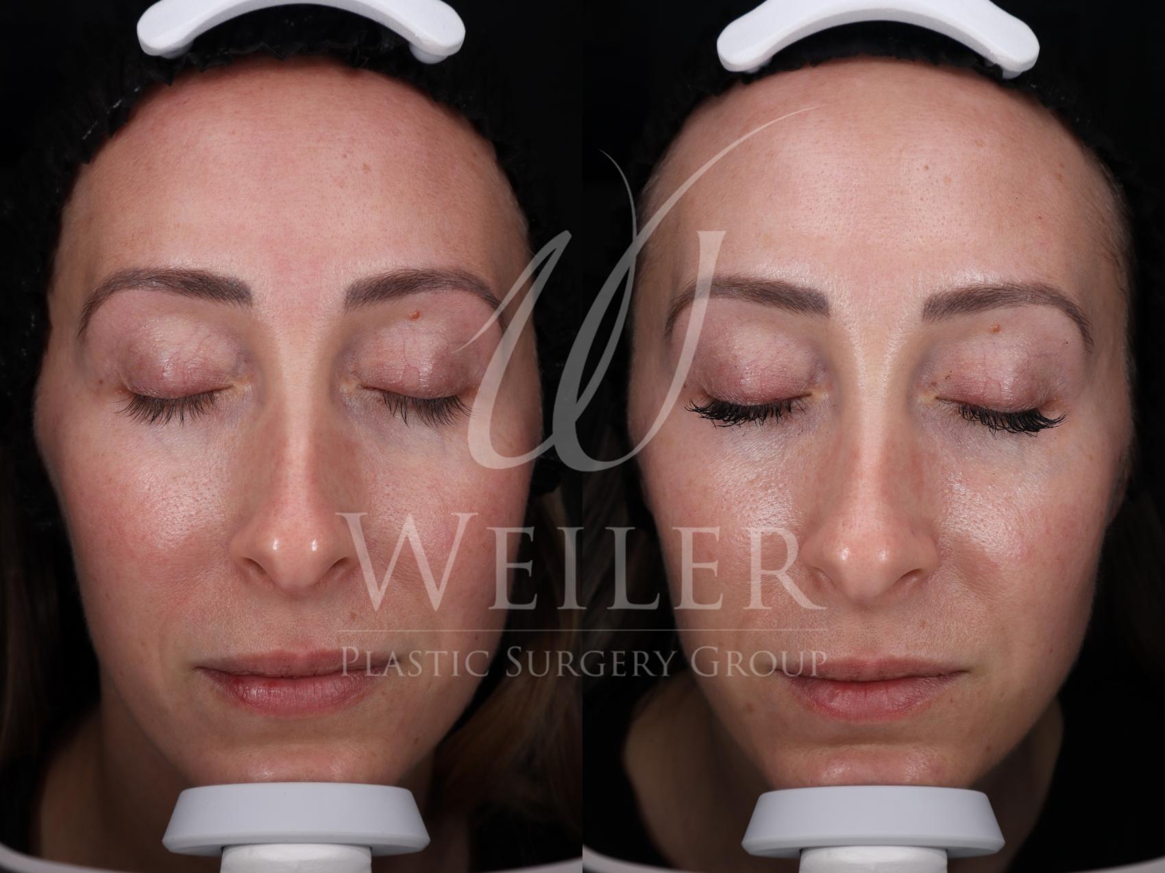 Before & After Microneedling Case 1729 Front View in Baton Rouge, New Orleans, & Lafayette, Louisiana