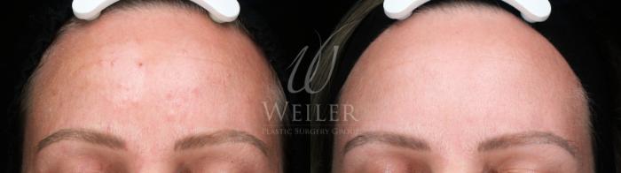 Before & After Microneedling Case 1821 Front View in Baton Rouge, New Orleans, & Lafayette, Louisiana