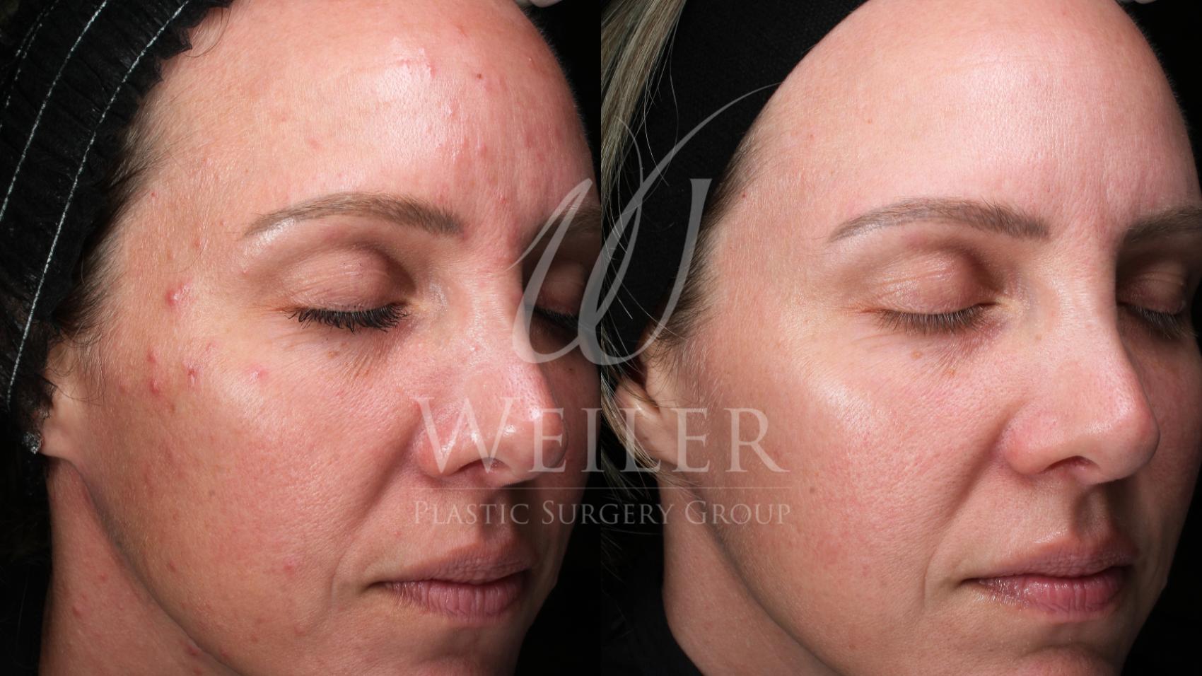 Before & After Microneedling Case 1821 Left Oblique View in Baton Rouge, New Orleans, & Lafayette, Louisiana