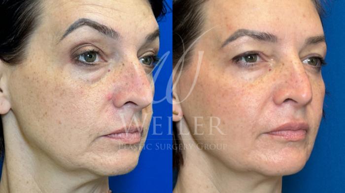 Before & After Midface Case 1192 Left Side View in Baton Rouge, Louisiana