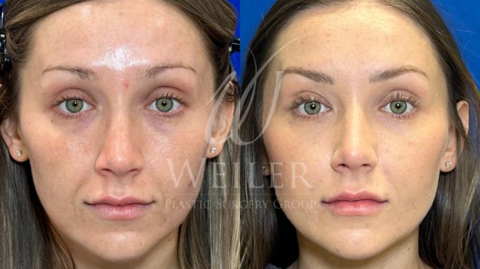 Before & After Restylane® Case 1242 Front View in Baton Rouge, New Orleans, & Lafayette, Louisiana