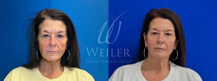 Before & After Midface Case 1246 Front View in Baton Rouge, Louisiana