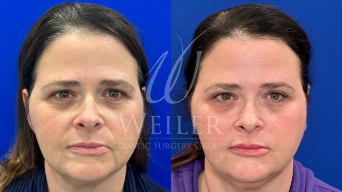 Before & After JUVÉDERM® Case 1256 Front View in Baton Rouge, New Orleans, & Lafayette, Louisiana