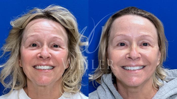Before & After Midface Case 1457 Back View in Baton Rouge, New Orleans, & Lafayette, Louisiana