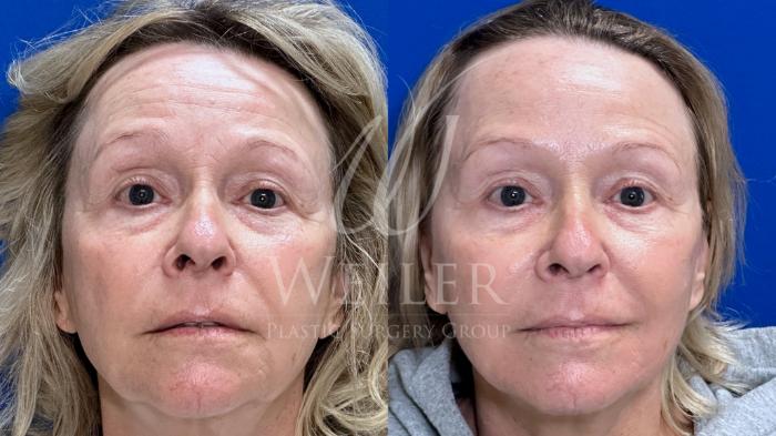 Before & After Midface Case 1457 Front View in Baton Rouge, New Orleans, & Lafayette, Louisiana