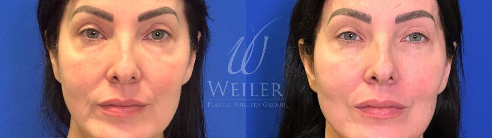 Before & After Midface Case 1613 Front View in Baton Rouge, New Orleans, & Lafayette, Louisiana