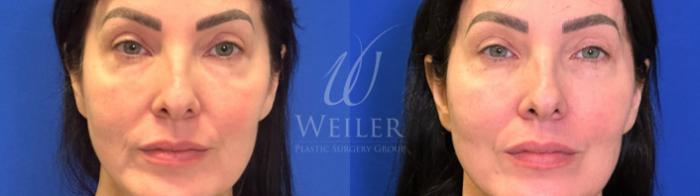 Before & After Midface Case 1613 Front View in Baton Rouge, New Orleans, & Lafayette, Louisiana