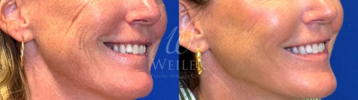 Before & After Midface Case 1685 Right Oblique View in Baton Rouge, New Orleans, & Lafayette, Louisiana