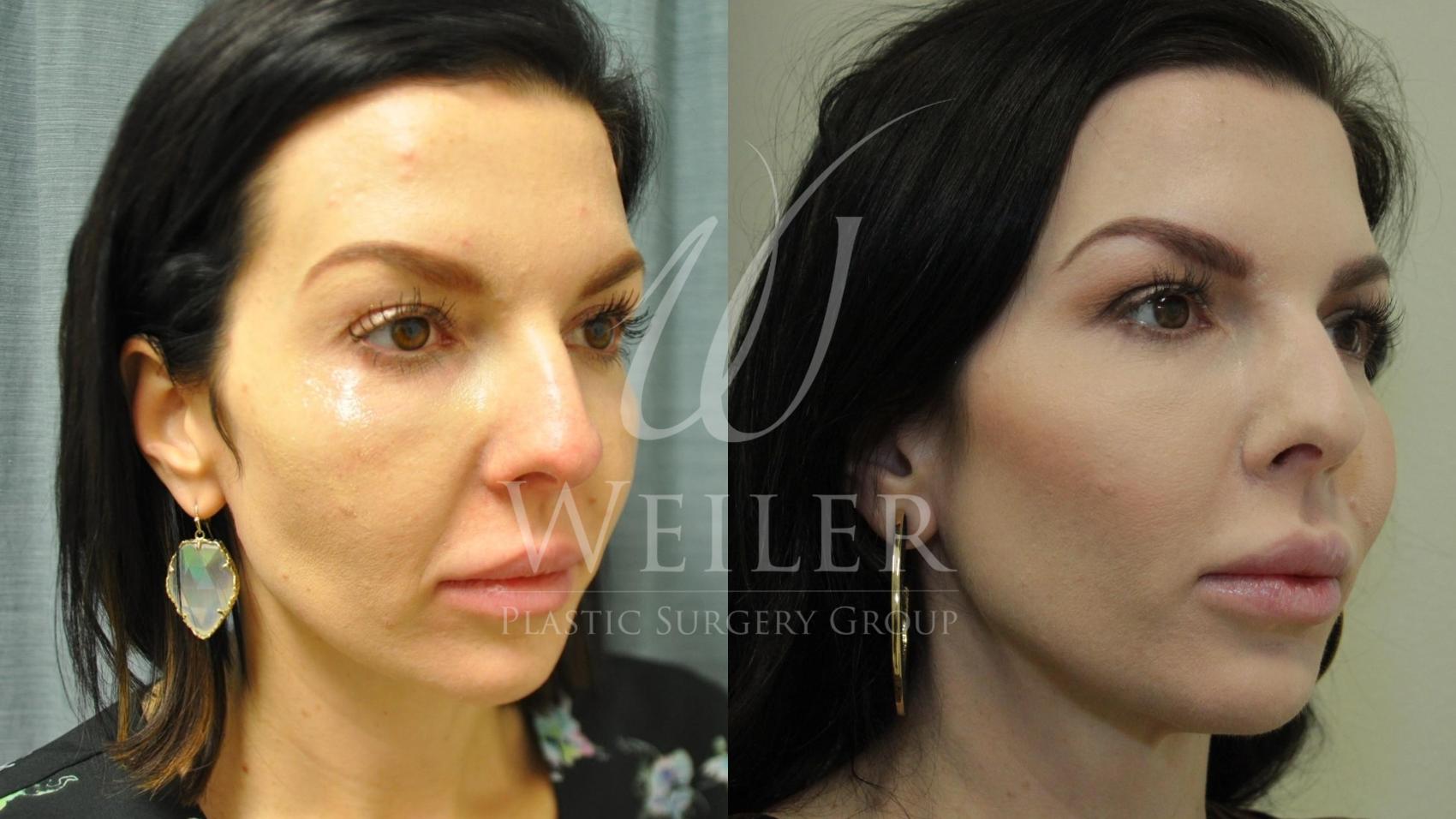 Before & After Midface Case 606 Right Oblique View in Baton Rouge, Louisiana