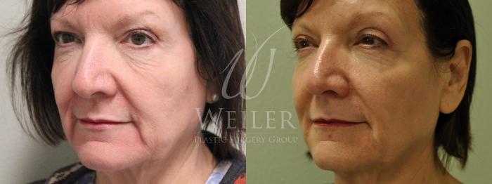Before & After Midface Case 607 Left Oblique View in Baton Rouge, Louisiana