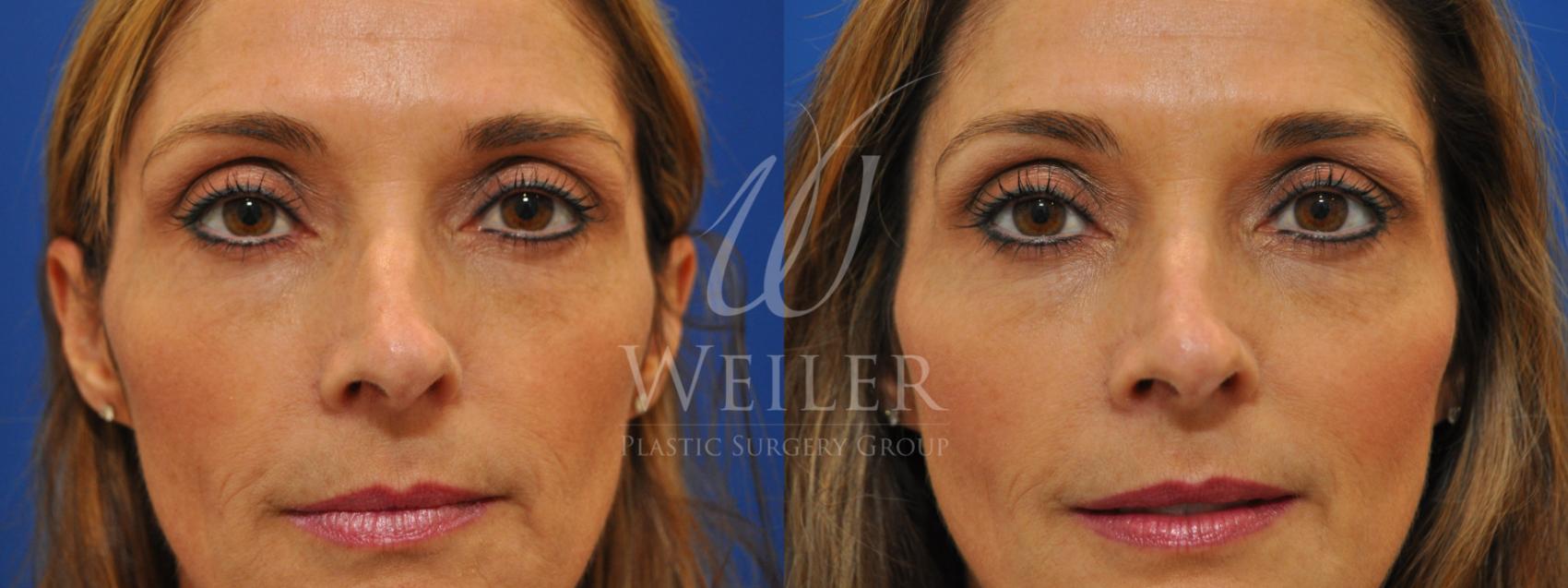 Before & After JUVÉDERM® Case 609 Front View in Baton Rouge, Louisiana