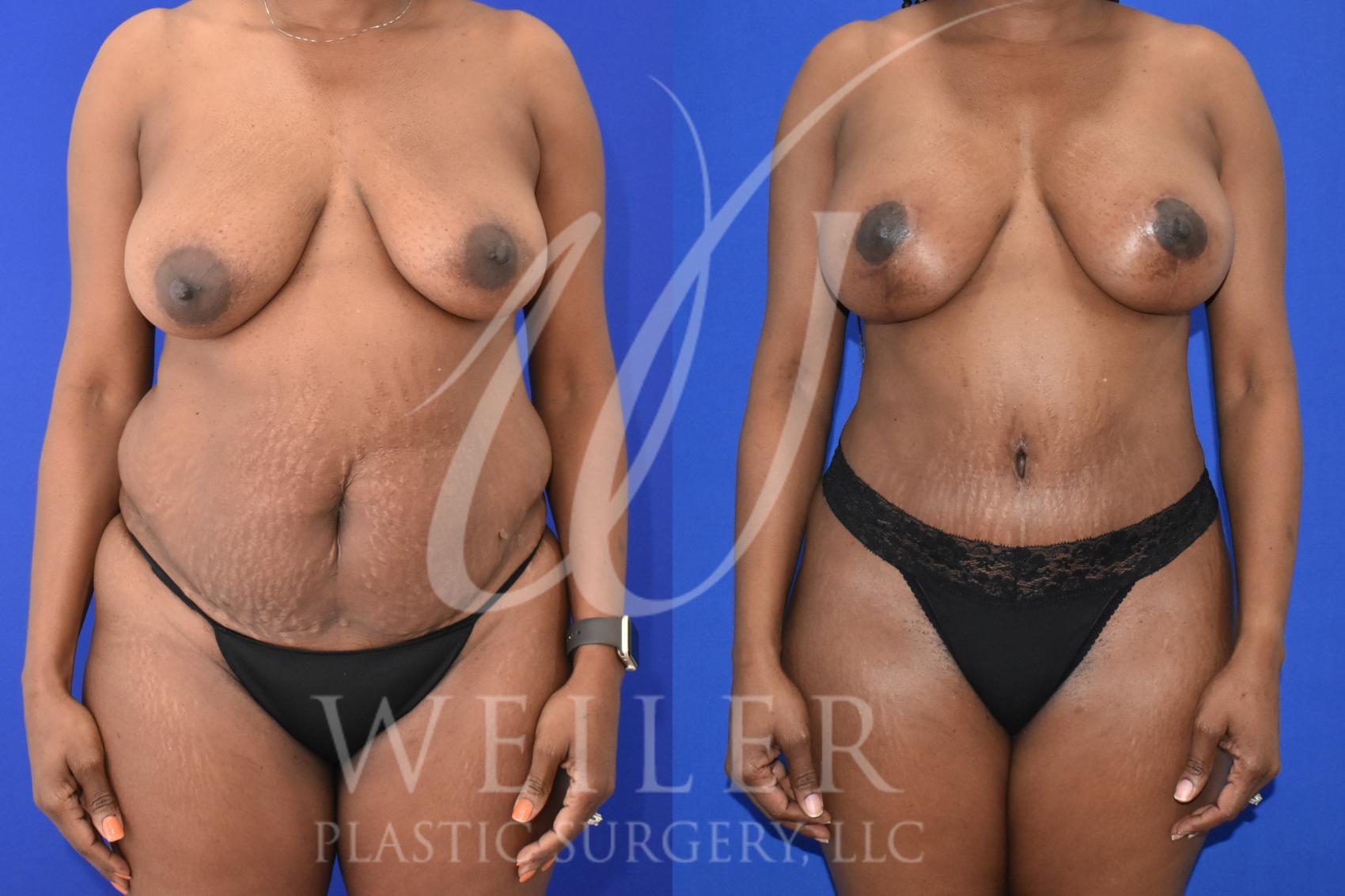 Before & After Mommy Makeover Case 1001 Front View in Baton Rouge, Louisiana