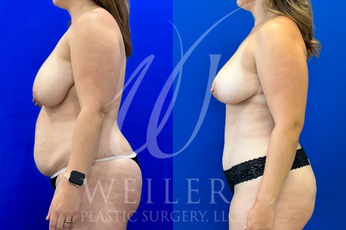 Before & After Mommy Makeover Case 1037 Left Side View in Baton Rouge, New Orleans, & Lafayette, Louisiana