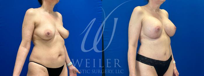 Before & After Mommy Makeover Case 1054 Right Oblique View in Baton Rouge, New Orleans, & Lafayette, Louisiana