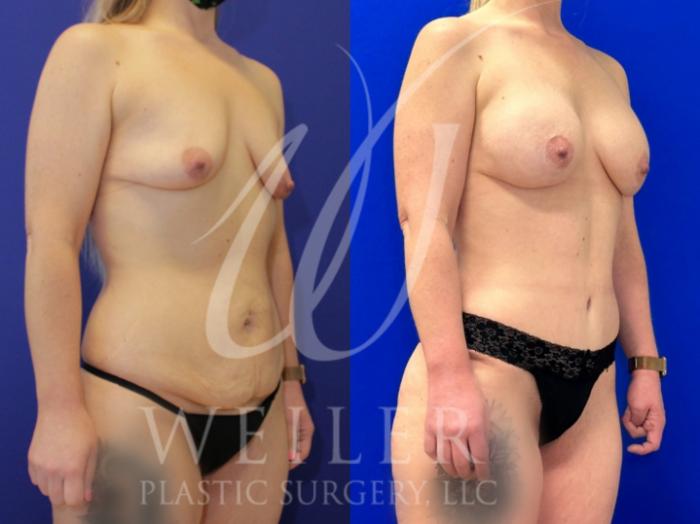 Before & After Mommy Makeover Case 1072 Right Oblique View in Baton Rouge, New Orleans, & Lafayette, Louisiana