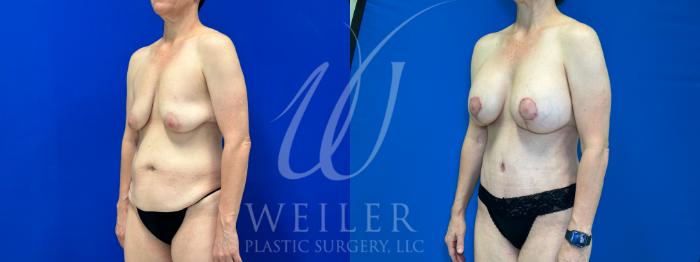 Before & After Mommy Makeover Case 1094 Left Oblique View in Baton Rouge, New Orleans, & Lafayette, Louisiana
