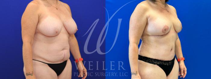 Before & After Mommy Makeover Case 1095 Right Oblique View in Baton Rouge, New Orleans, & Lafayette, Louisiana