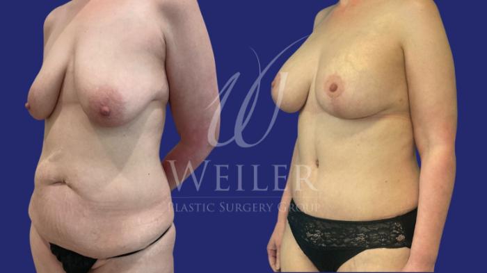 Before & After Mommy Makeover Case 1209 Left Oblique View in Baton Rouge, New Orleans, & Lafayette, Louisiana