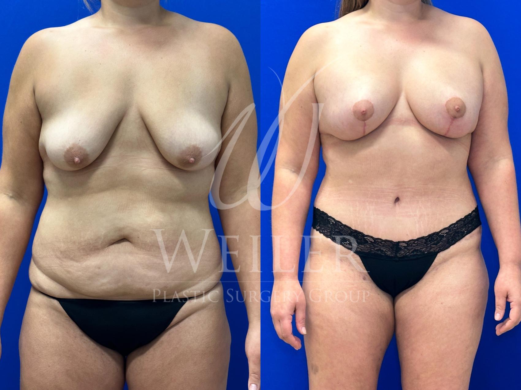 Before & After Tummy Tuck Case 1224 Front View in Baton Rouge, New Orleans, & Lafayette, Louisiana