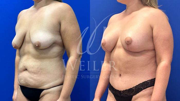 Before & After Breast Lift with Augmentation Case 1224 Left Oblique View in Baton Rouge, New Orleans, & Lafayette, Louisiana