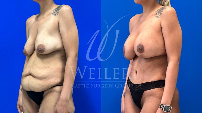 Before & After Mommy Makeover Case 1249 Right Oblique View in Baton Rouge, New Orleans, & Lafayette, Louisiana