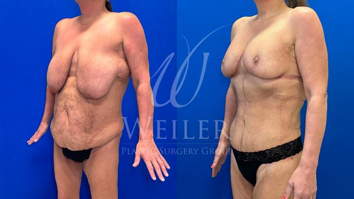 Before & After Mommy Makeover Case 1278 Left Oblique View in Baton Rouge, New Orleans, & Lafayette, Louisiana