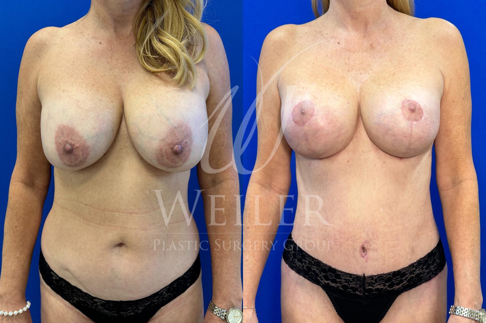 Before & After Mommy Makeover Case 1481 Front View in Baton Rouge, New Orleans, & Lafayette, Louisiana