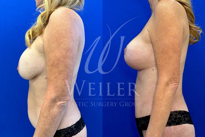 Before & After Mommy Makeover Case 1481 Left Side View in Baton Rouge, New Orleans, & Lafayette, Louisiana