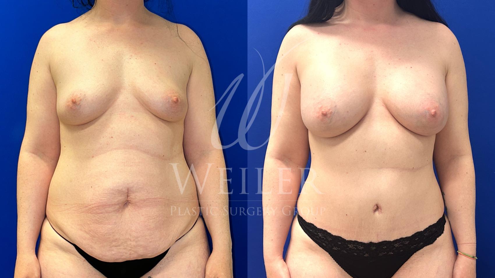 Before & After Mommy Makeover Case 1497 Front View in Baton Rouge, New Orleans, & Lafayette, Louisiana