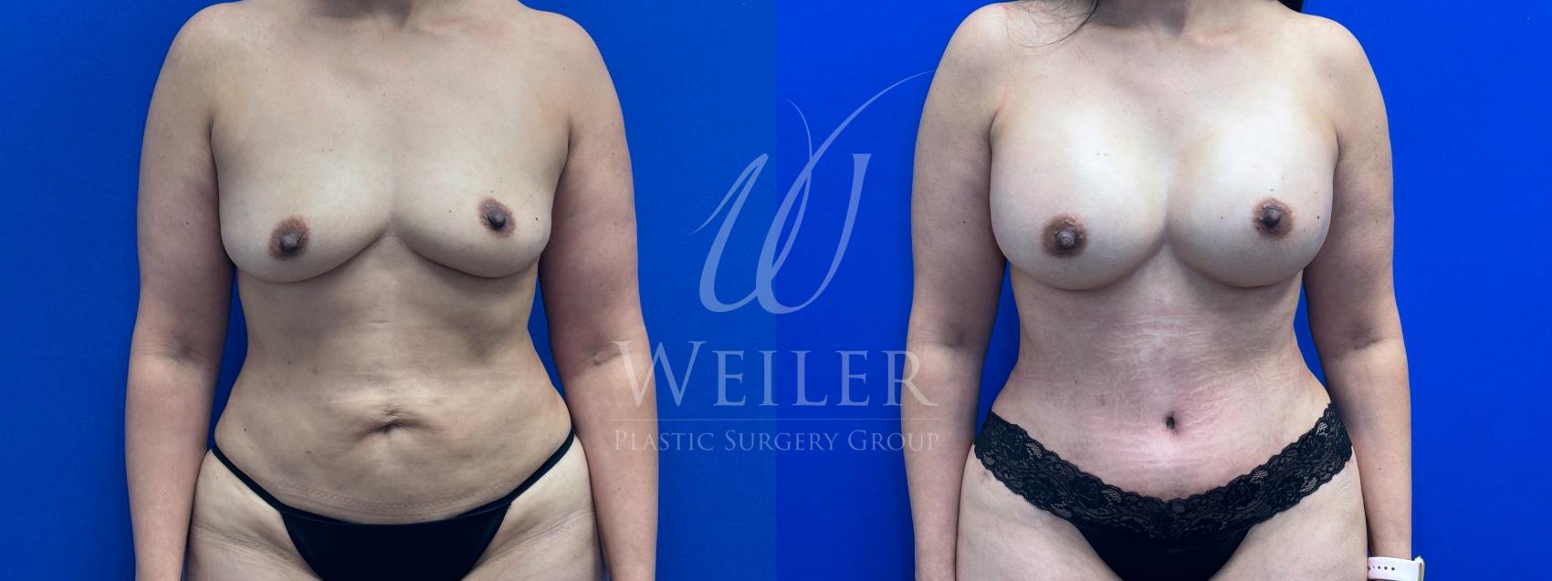 Before & After Mommy Makeover Case 1501 Front View in Baton Rouge, New Orleans, & Lafayette, Louisiana