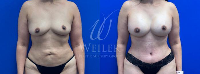 Before & After Mommy Makeover Case 1501 Front View in Baton Rouge, New Orleans, & Lafayette, Louisiana