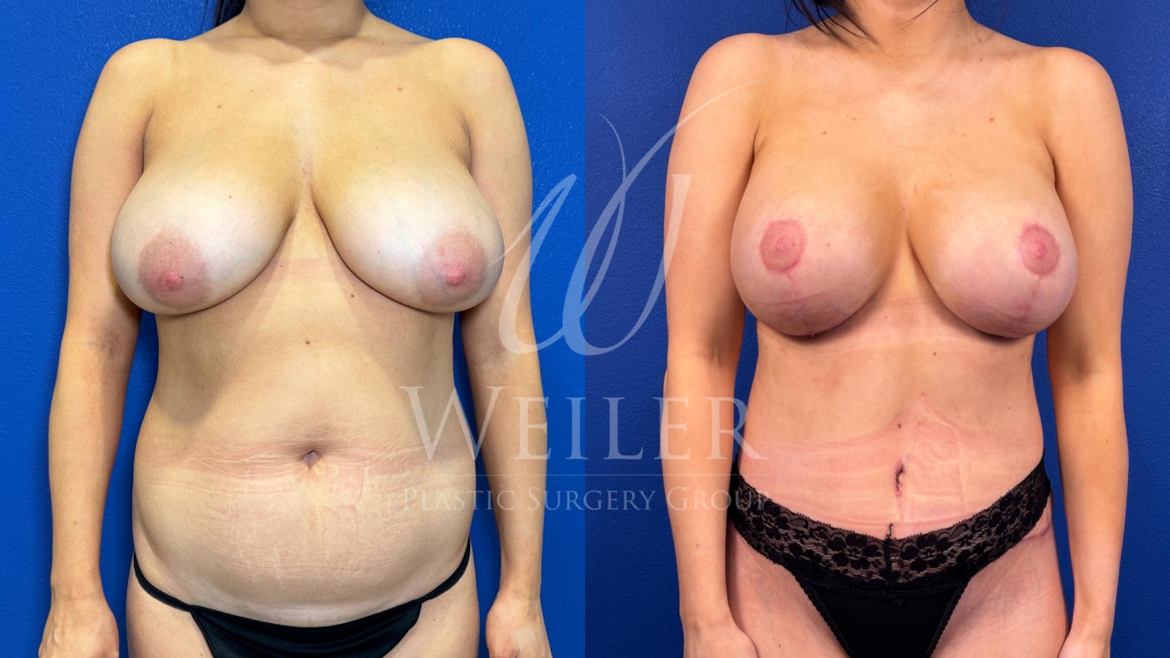 Before & After Breast Lift with Augmentation Case 1573 Front View in Baton Rouge, New Orleans, & Lafayette, Louisiana